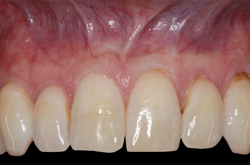 Healthy smile with root structure covered at gum grafting