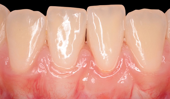 Smiel tooth root covered after gum grafting treatment
