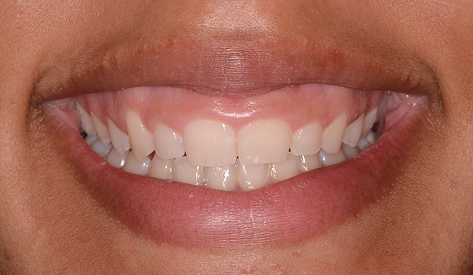 Stubby teeth before aesthetic gum recontouring treatment