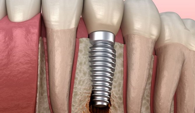 Illustration of infection around a dental implant