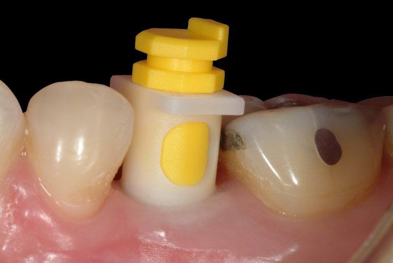 Cylinder in place to capture an impression of the newly placed implant abutment