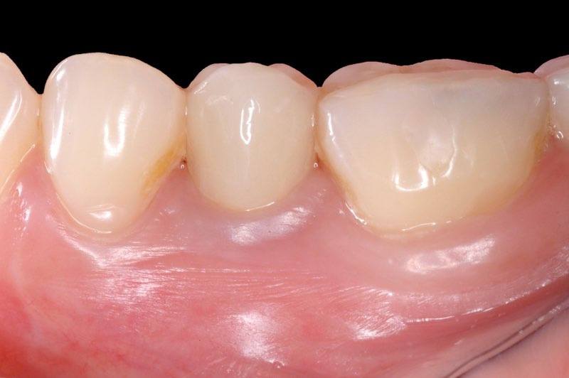 Dental implant supported dental crown seamlessly integrated into smile