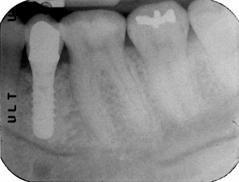 X-ray of dental implant supported dental crown after 3 years
