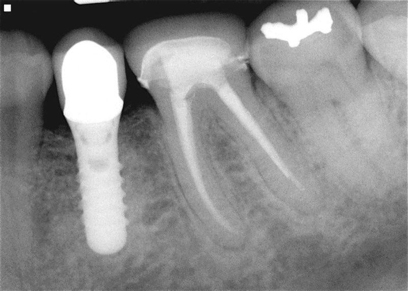 X-ray of dental implant supported dental crown after 7 years
