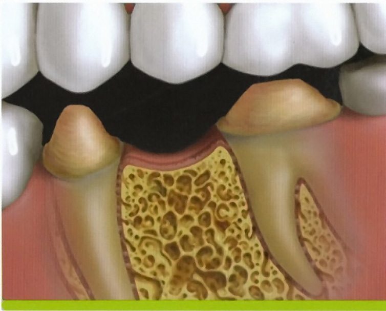 Animated rending of teeth prepared for traditional fixed bridge