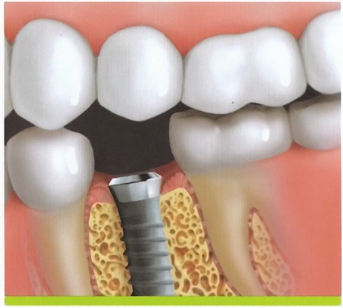 Animated image of smile after dental implant post is placeD