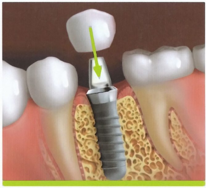 Animated dental crown attached to dental implant post