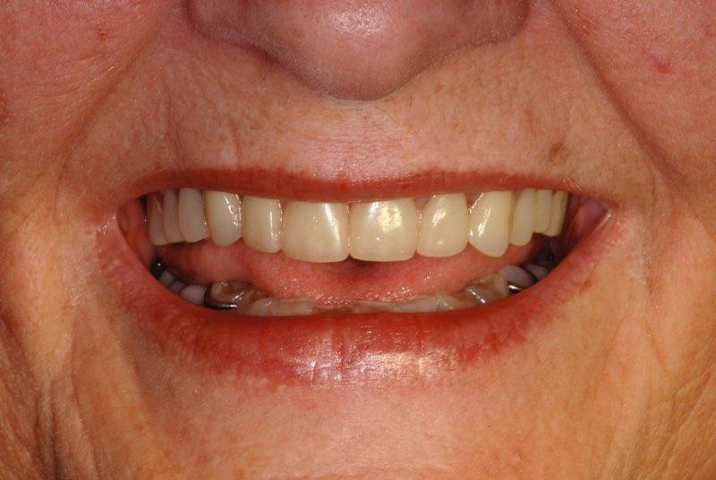 Smile after denture placement