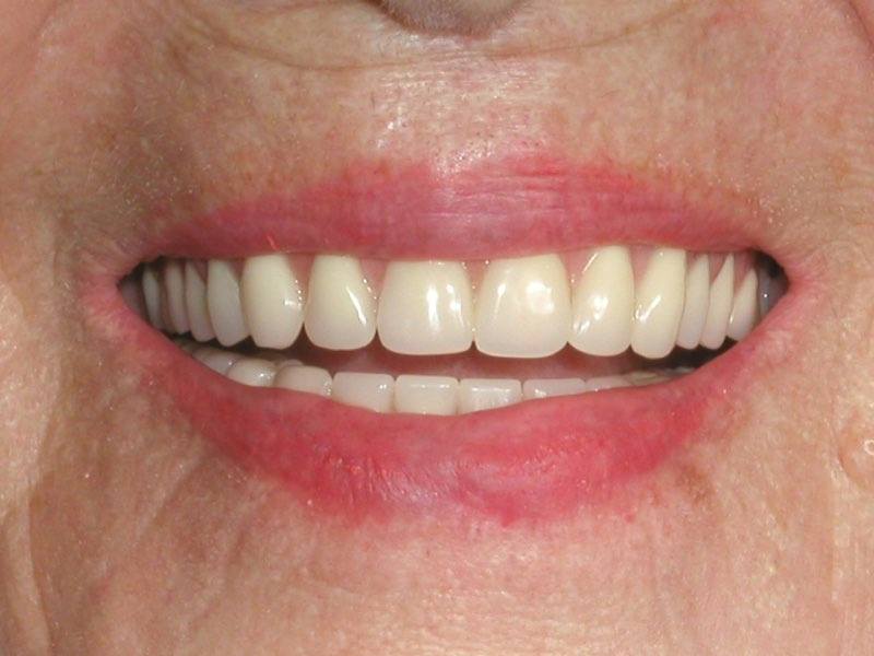 Smile with dental implant supported denture