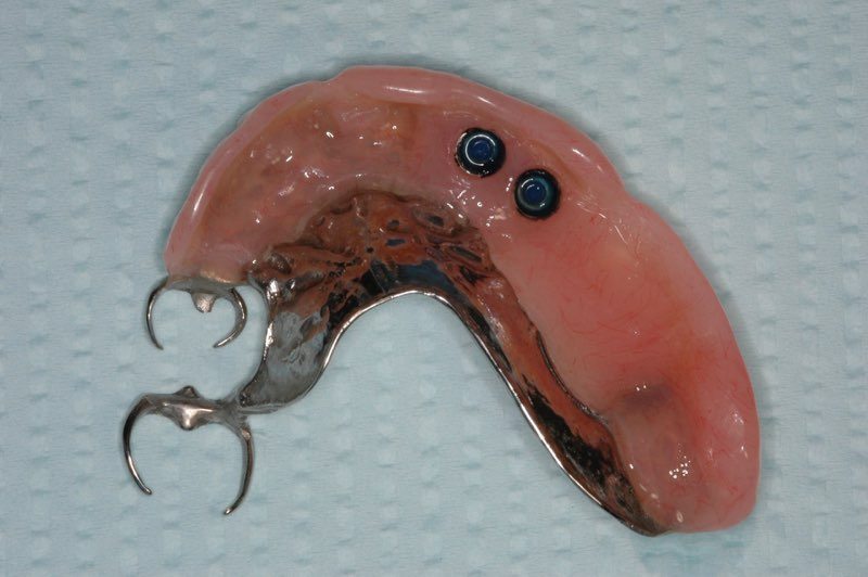 Partial denture with buttons to attach to dental implants