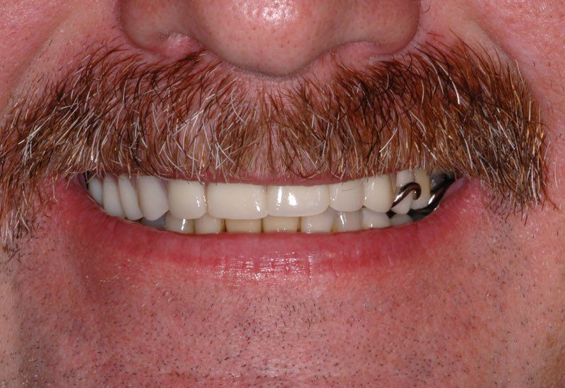 Smile after partial denture is placed