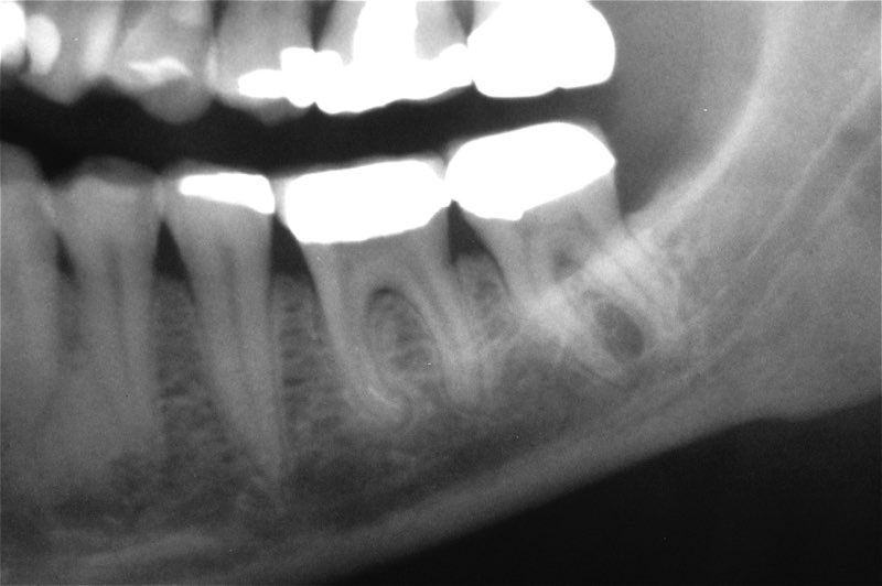 X-ray of severely damaged teeth