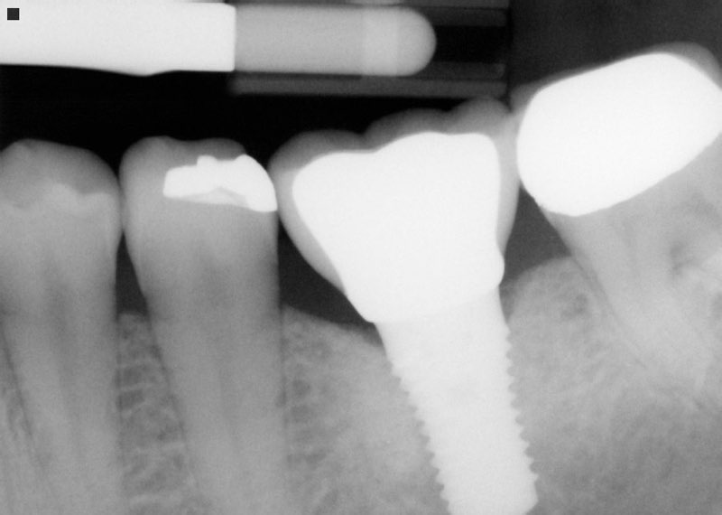 X-ray of smile after dental implant and dental crown placement