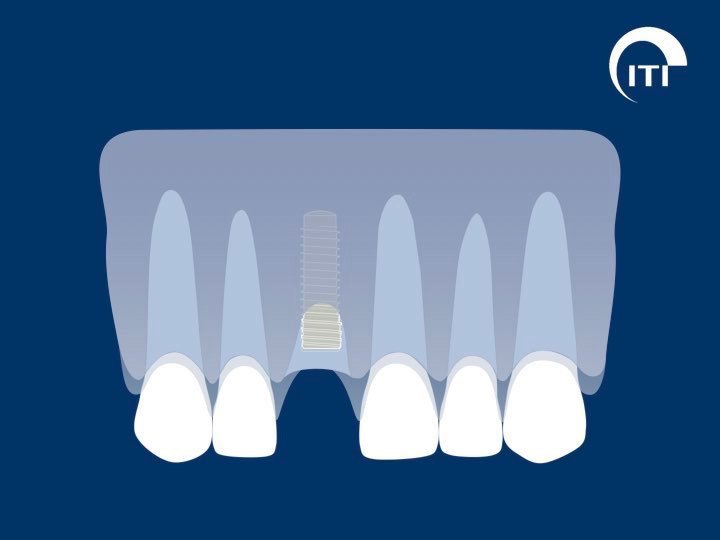 Animated smile with dental implant post