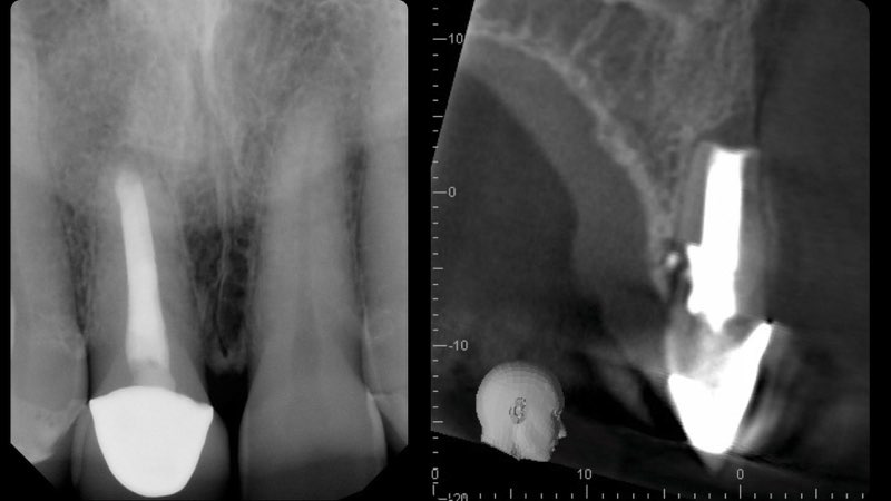 X-rays and C T scan of damaged tooth