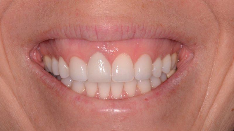 Patient smiling before dental implant restoration