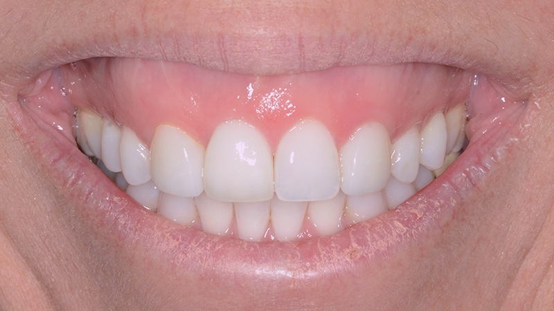 Smiling patient after dental implant tooth replacement
