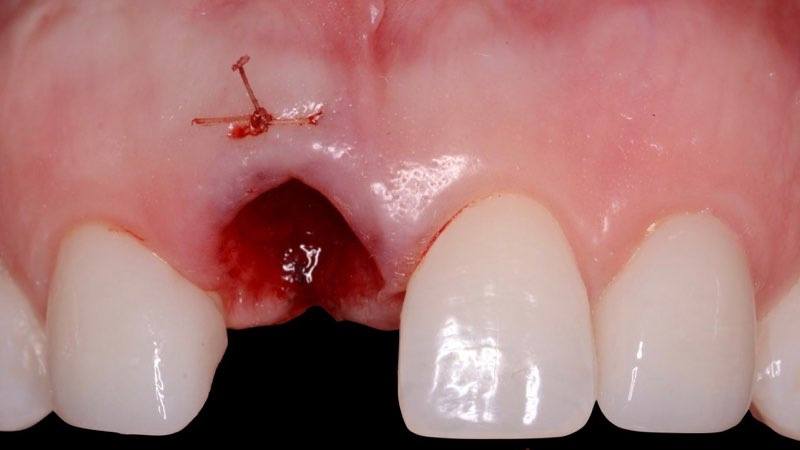 Damaged gum tissue after tooth extraction