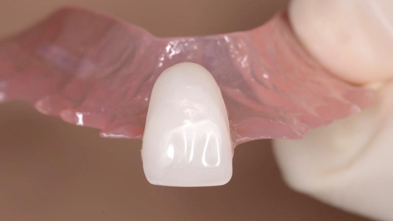 Temporary partial denture used during dental implant process