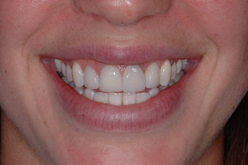 Smile with damaged front tooth