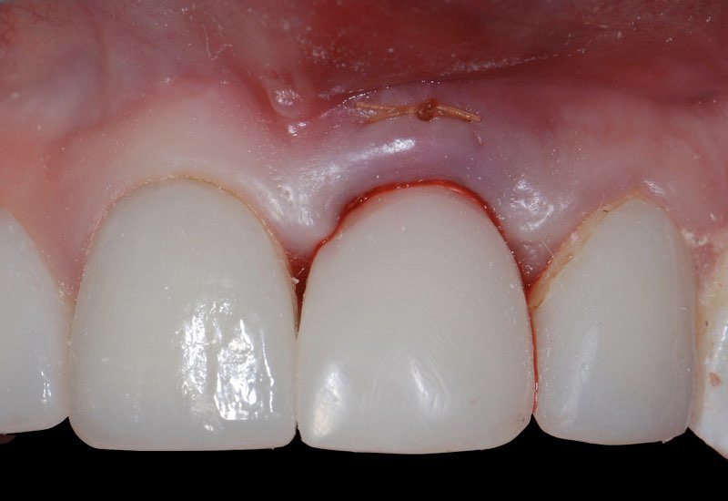 Smile with temporary dental crown tooth replacement