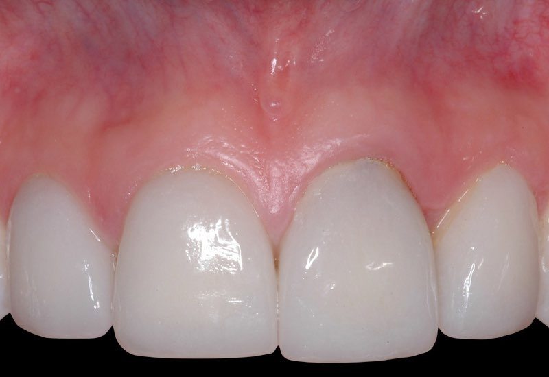 Smile with damaged front tooth and gum recession