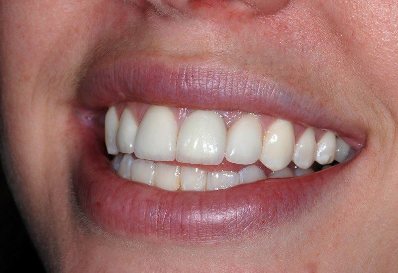 Full smile after dental implant tooth replacement