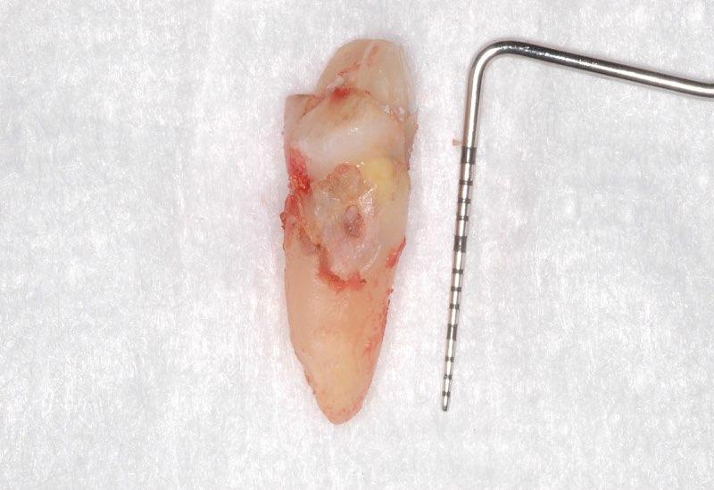 Damaged tooth after extraction