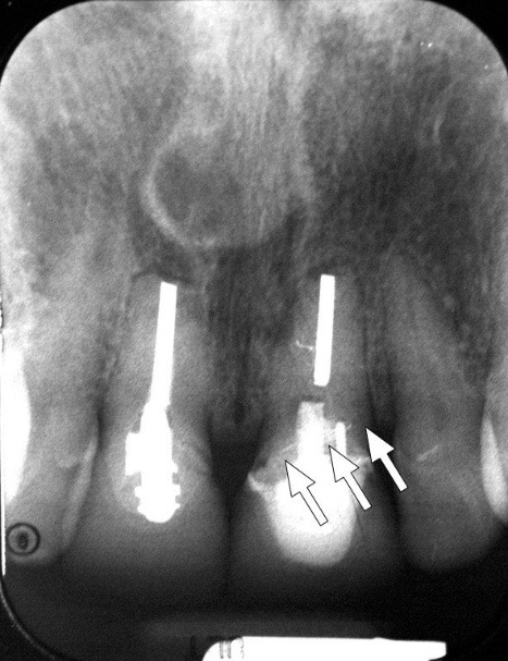 X-ray with arrows pointing to tooth fracture