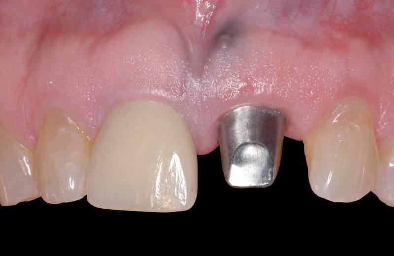 Smile with custom abutment post visible