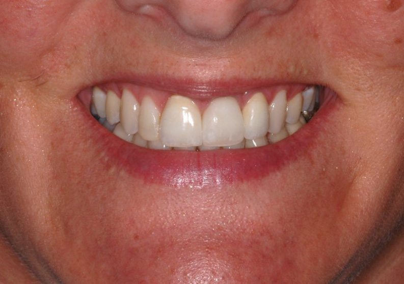 Patient's full smile after dental implant tooth replacement