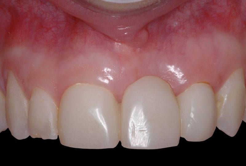 Smile with temporary bridge on the day of dental implant placement surgery