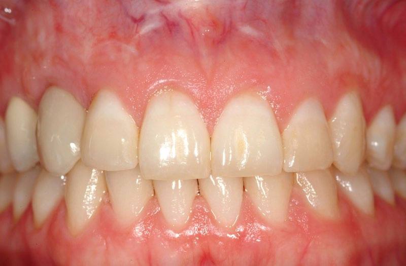 Smile two years after dental implant tooth replacement