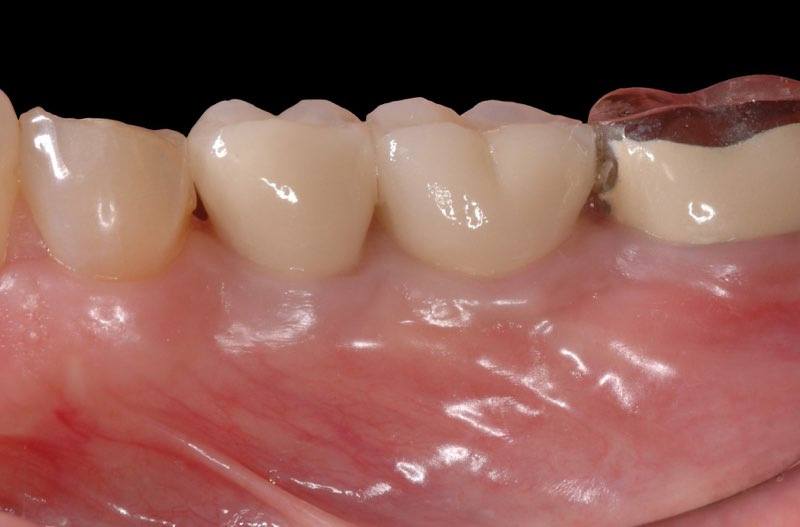 Replacement teeth in place attached to dental implants
