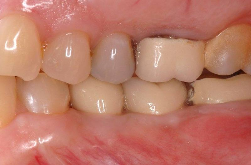 Full smile with dental crowns attached to dental implant posts