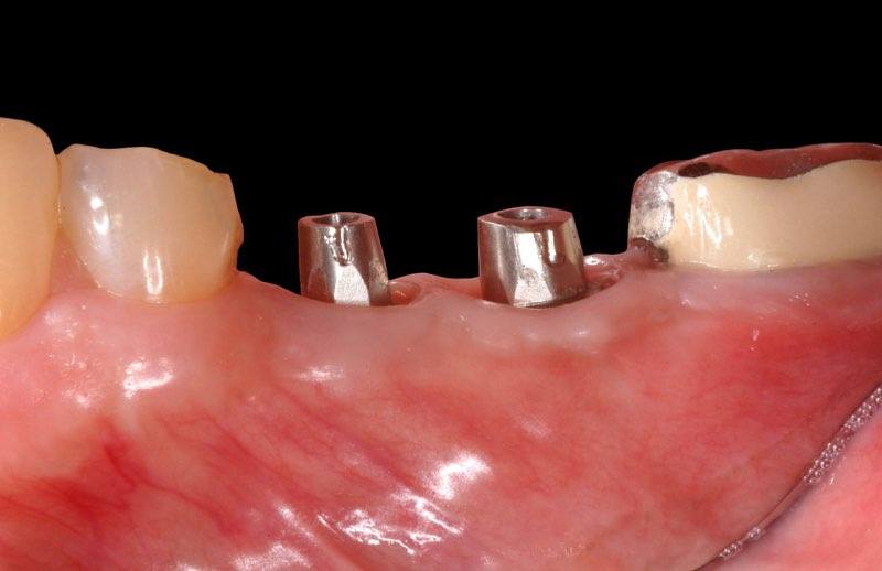 Dental implant abutments visible above the gum line