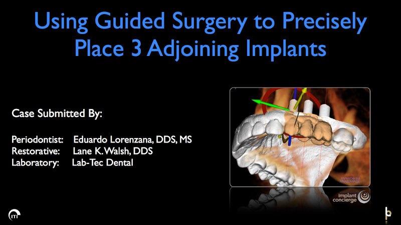 3 D surgical guide for precise dental implant placement