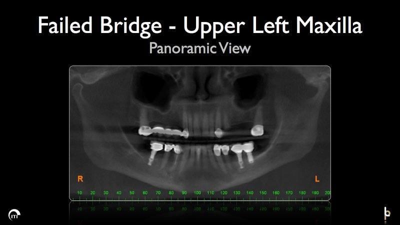 X-ray of smile with failed dental bridge