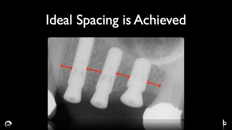 X-ray showing ideal spacing between dental implant posts