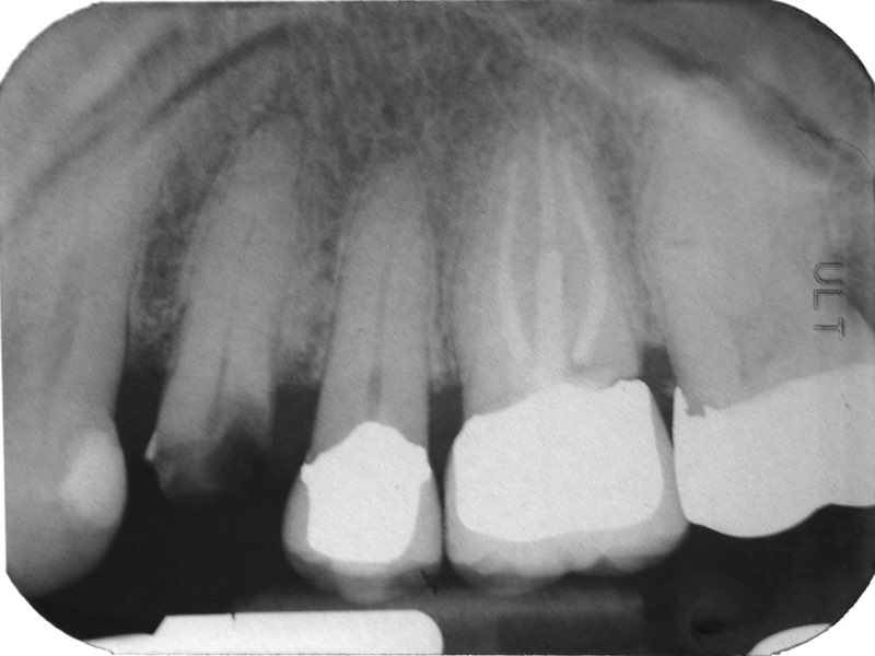 X-ray of fractured tooth