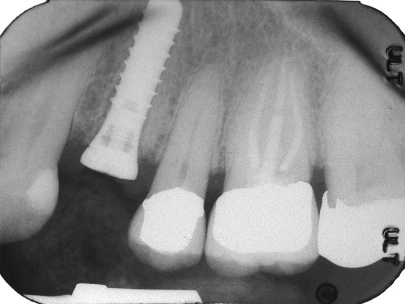 X-ray of smile with dental implant post