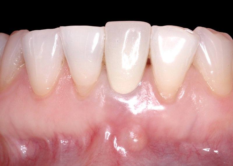 Lower front tooth with dental damage