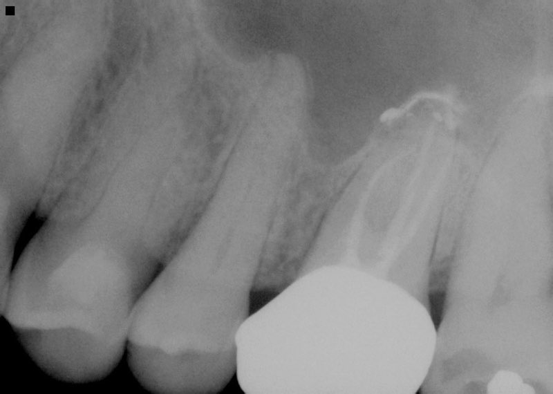 X-ray of tooth with extensive damage