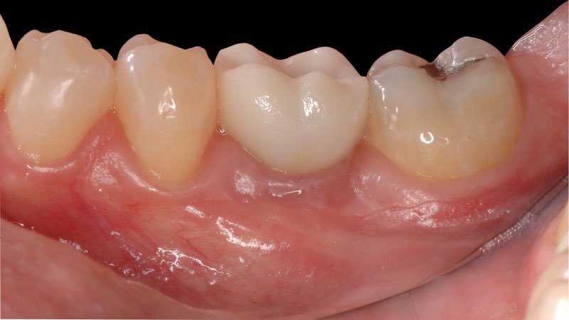Custom dental crown in place over dental implant