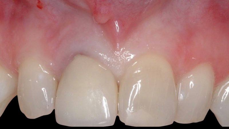 Image of a fractured front tooth