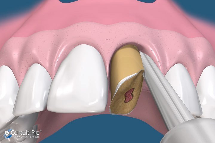Animated tooth extraction process that minimizes bone loss