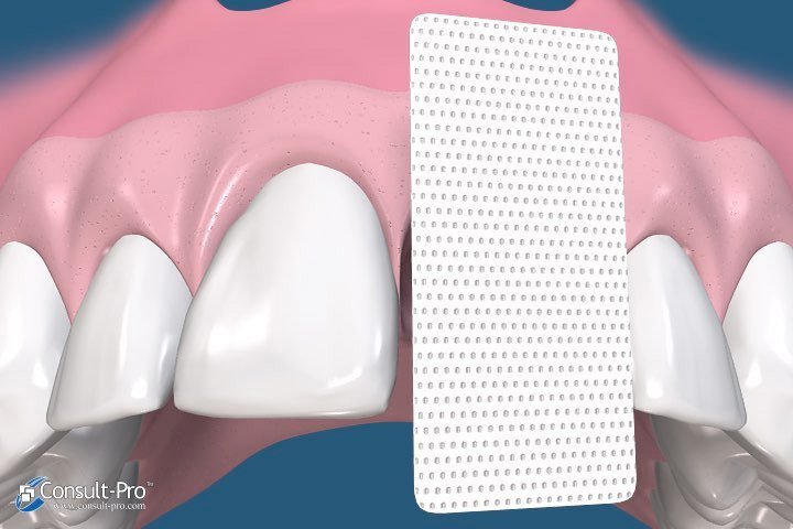 Animated smile with cytoplast membrane
