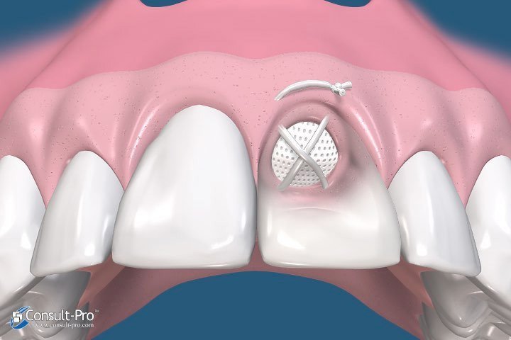 Animated rendering of smile with membrane in place