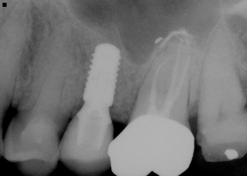 X-ray of smile after completed dental implant tooth replacement