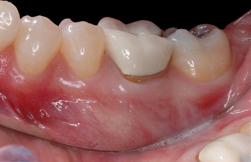 Smile with severely damaged back tooth